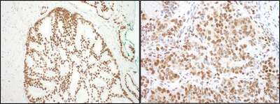 Detection of Human and Mouse SF3B3 by Immunohistochemistry. Sample: FFPE sections of human prostate carcinoma (left) and mouse teratoma (right). Antibody: Affinity purified rabbit anti-SF3B3 used at a dilution of 1:200 (1 ug/ml). Detection: DAB.