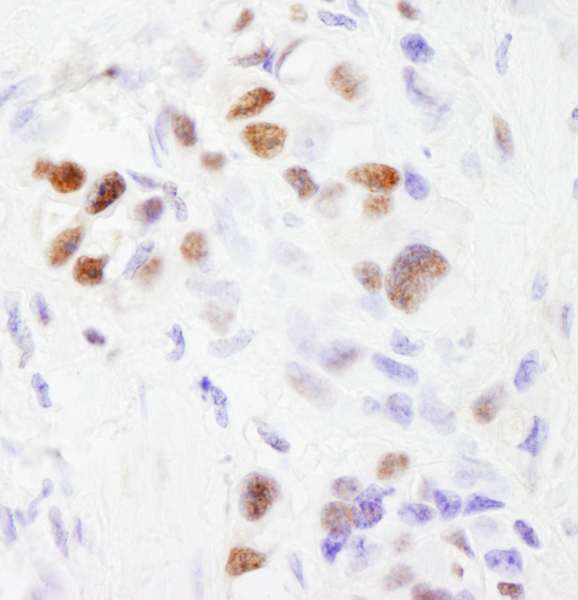 Detection of Human SF3b145/SAP145 by Immunohistochemistry. Sample: FFPE section of human linitis plastica stomach cancer. Antibody: Affinity purified rabbit anti-SF3b145/SAP145 used at a dilution of 1:200 (1 ug/ml). Detection: DAB.