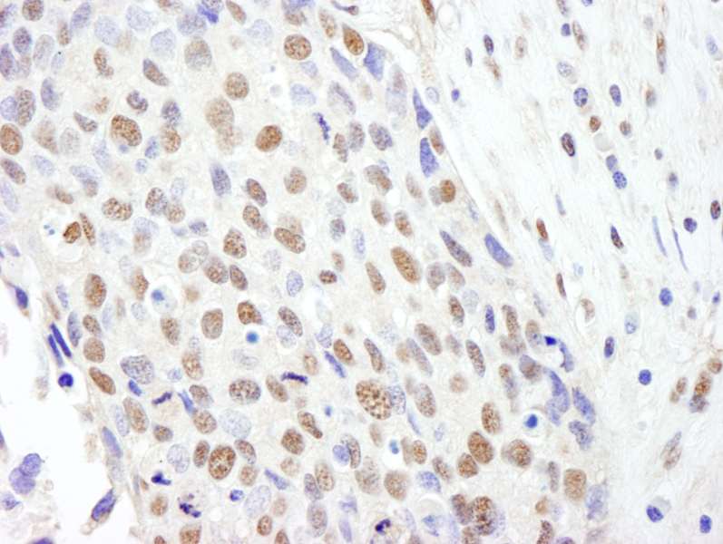 Detection of Human SF3b145/SAP145 by Immunohistochemistry. Sample: FFPE section of human breast carcinoma. Antibody: Affinity purified rabbit anti-SF3b145/SAP145 used at a dilution of 1:200 (1 ug/ml). Detection: DAB.