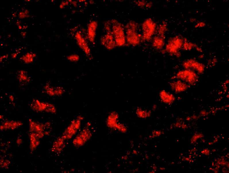 Detection of Human SF3b145/SAP145 by IHC-IF. Sample: FFPE section of human stomach carcinoma. Antibody: Affinity purified rabbit anti-SF3b145/SAP145 used at a dilution of 1:100. Detection: Red-fluorescent goat anti-rabbit IgG highly cross-adsorbed Antibody used at a dilution of 1:100.