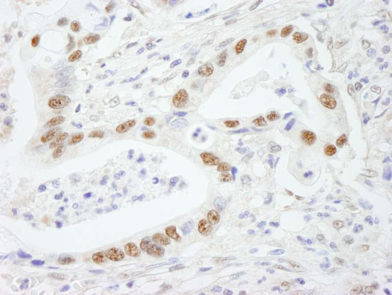 Detection of Human SF3b145/SAP145 by Immunohistochemistry. Sample: FFPE section of human stomach carcinoma. Antibody: Affinity purified rabbit anti-SF3b145/SAP145 used at a dilution of 1:250.
