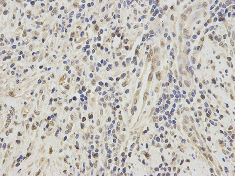 Immunohistochemistry of paraffin-embedded human stomach cancer using SFRS1 antibody at dilution of 1:200 (400x lens).