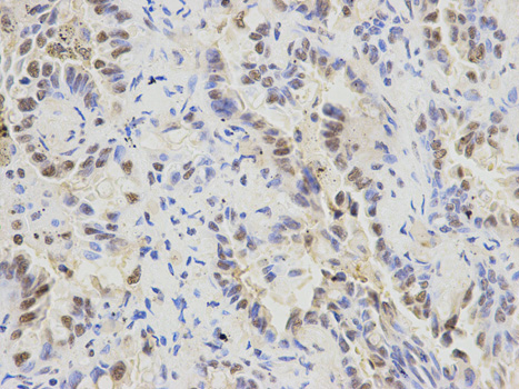 Immunohistochemistry of paraffin-embedded human lung cancer using SFRS1 antibody at dilution of 1:200 (400x lens).