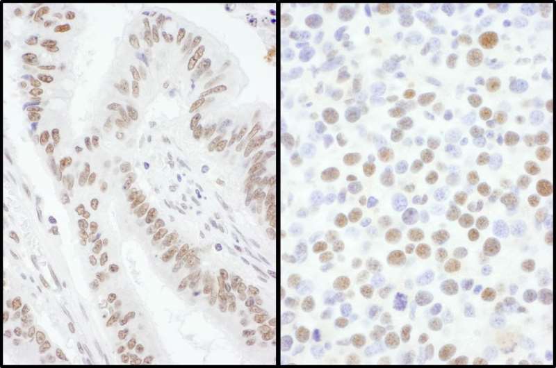 Detection of Human and Mouse SRSF7 by Immunohistochemistry. Sample: FFPE sections of human colon carcinoma (left) and mouse renal cell carcinoma (right). Antibody: Affinity purified rabbit anti-SRSF7 used at a dilution of 1:5000 (0.2 ug/ml) and 1:1000 (1 ug/ml). Detection: DAB.