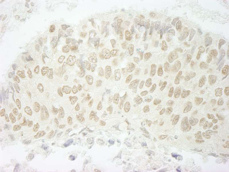 Detection of Human SFRS8/SWAP by Immunohistochemistry. Sample: FFPE section of human lung carcinoma. Antibody: Affinity purified rabbit anti-SFRS8/SWAP used at a dilution of 1:100. Epitope Retrieval Buffer-High pH (IHC-101J) was substituted for Epitope Retrieval Buffer-Reduced pH.