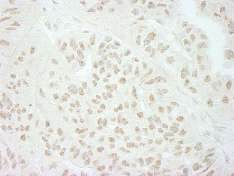 Detection of Human SFRS8/SWAP by Immunohistochemistry. Sample: FFPE section of human breast carcinoma. Antibody: Affinity purified rabbit anti-SFRS8/SWAP used at a dilution of 1:200 (1 ug/ml). Detection: DAB.