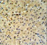 PSME1 Antibody IHC of formalin-fixed and paraffin-embedded hepatocarcinoma followed by peroxidase-conjugated secondary antibody and DAB staining.