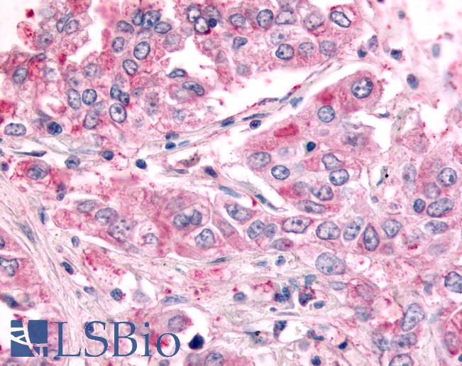 Anti-SGK2 antibody IHC of human Lung, Non-Small Cell Carcinoma. Immunohistochemistry of formalin-fixed, paraffin-embedded tissue after heat-induced antigen retrieval.