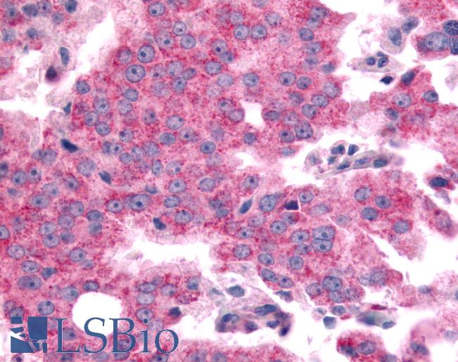 Anti-SGK2 antibody IHC of human Prostate, Carcinoma. Immunohistochemistry of formalin-fixed, paraffin-embedded tissue after heat-induced antigen retrieval.