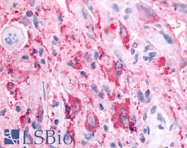 Anti-SGK2 antibody IHC of human Brain, Glioblastoma. Immunohistochemistry of formalin-fixed, paraffin-embedded tissue after heat-induced antigen retrieval.