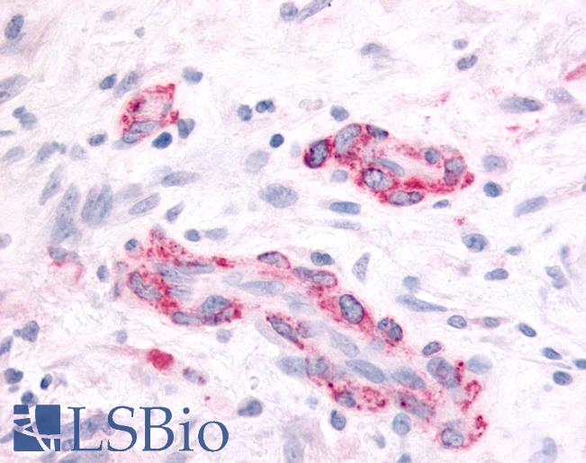 Anti-SGK2 antibody IHC of human Brain, Glioblastoma. Immunohistochemistry of formalin-fixed, paraffin-embedded tissue after heat-induced antigen retrieval.