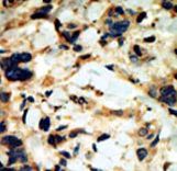 Formalin-fixed and paraffin-embedded human cancer tissue reacted with the primary antibody, which was peroxidase-conjugated to the secondary antibody, followed by DAB staining. This data demonstrates the use of this antibody for immunohistochemistry; clinical relevance has not been evaluated. BC = breast carcinoma; HC = hepatocarcinoma.
