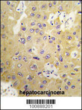 Formalin-fixed and paraffin-embedded human hepatocarcinoma tissue reacted with SGK3 Antibody , which was peroxidase-conjugated to the secondary antibody, followed by DAB staining. This data demonstrates the use of this antibody for immunohistochemistry; clinical relevance has not been evaluated.