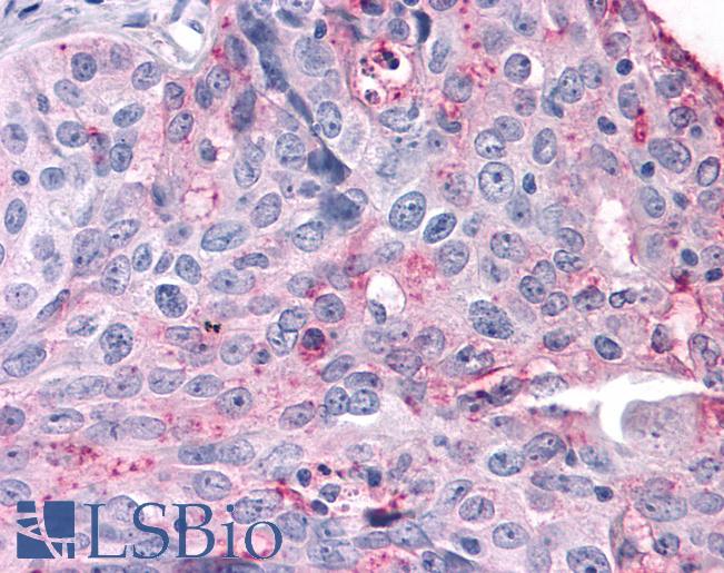 Anti-SGK3 antibody IHC of human Ovary, Carcinoma. Immunohistochemistry of formalin-fixed, paraffin-embedded tissue after heat-induced antigen retrieval.