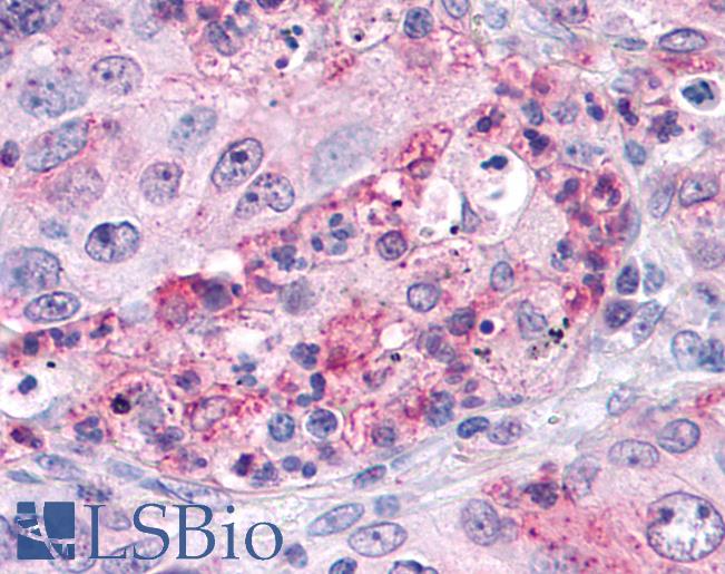 Anti-SGK3 antibody IHC of human Lung, Non-Small Cell Carcinoma. Immunohistochemistry of formalin-fixed, paraffin-embedded tissue after heat-induced antigen retrieval.