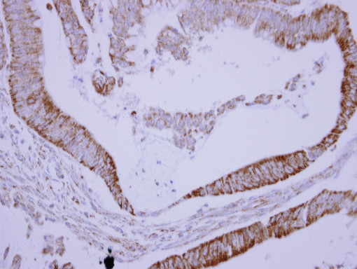 IHC of paraffin-embedded Colon carcinoma, using SH3BP5 antibody at 1:250 dilution.