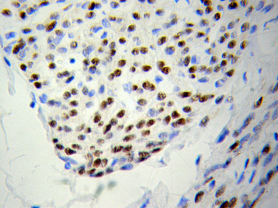 Immunohistochemistry (IHC) analysis of PSME3 pAb in paraffin-embedded Colon cancer tissue.