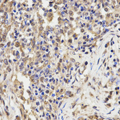 Immunohistochemistry of paraffin-embedded human lung cancer using PSME3 antibody at dilution of 1:200 (x400 lens).