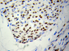 Immunohistochemistry of paraffin-embedded Colon cancer using PSME3 antibody.