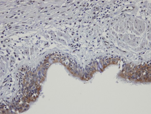 IHC of paraffin-embedded PC13 xenograft using SHKBP1 antibody at 1:100 dilution.