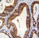 SHQ1 Antibody immunohistochemistry of formalin-fixed and paraffin-embedded human prostate carcinoma followed by peroxidase-conjugated secondary antibody and DAB staining.