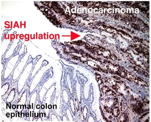 Staining of SIAH in human colorectal adenocarcinoma. Staining of SIAH was not observed in normal colon epithelium.