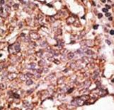 Formalin-fixed and paraffin-embedded human cancer tissue reacted with the primary antibody, which was peroxidase-conjugated to the secondary antibody, followed by AEC staining. This data demonstrates the use of this antibody for immunohistochemistry; clinical relevance has not been evaluated. BC = breast carcinoma; HC = hepatocarcinoma.