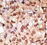 Formalin-fixed and paraffin-embedded human cancer tissue reacted with the primary antibody, which was peroxidase-conjugated to the secondary antibody, followed by DAB staining. This data demonstrates the use of this antibody for immunohistochemistry; clinical relevance has not been evaluated. BC = breast carcinoma; HC = hepatocarcinoma.