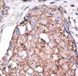 Formalin-fixed and paraffin-embedded human cancer tissue reacted with the primary antibody, which was peroxidase-conjugated to the secondary antibody, followed by AEC staining. This data demonstrates the use of this antibody for immunohistochemistry; clinical relevance has not been evaluated. BC = breast carcinoma; HC = hepatocarcinoma.
