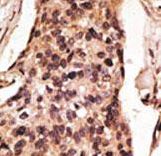 Formalin-fixed and paraffin-embedded human cancer tissue reacted with the primary antibody, which was peroxidase-conjugated to the secondary antibody, followed by DAB staining. This data demonstrates the use of this antibody for immunohistochemistry; clinical relevance has not been evaluated. BC = breast carcinoma; HC = hepatocarcinoma.
