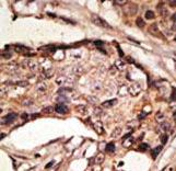 Formalin-fixed and paraffin-embedded human cancer tissue reacted with the primary antibody, which was peroxidase-conjugated to the secondary antibody, followed by AEC staining. This data demonstrates the use of this antibody for immunohistochemistry; clinical relevance has not been evaluated. BC = breast carcinoma; HC = hepatocarcinoma.