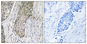 IHC of paraffin-embedded human lung carcinoma tissue, using QSK Antibody. The picture on the right is treated with the synthesized peptide.