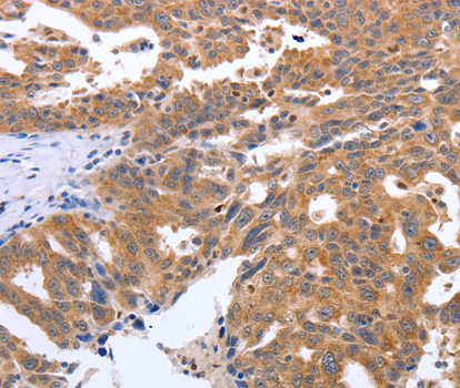 Immunohistochemistry of paraffin-embedded human ovarian cancer tissue using GEMIN2 antibody.