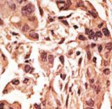 Formalin-fixed and paraffin-embedded human cancer tissue reacted with the primary antibody, which was peroxidase-conjugated to the secondary antibody, followed by DAB staining. This data demonstrates the use of this antibody for immunohistochemistry; clinical relevance has not been evaluated. BC = breast carcinoma; HC = hepatocarcinoma.