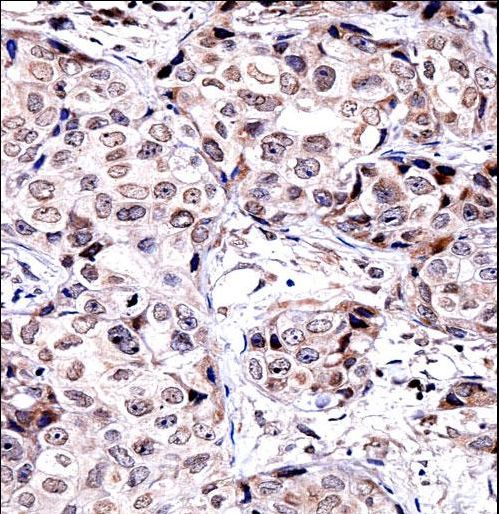 SIRT6 Antibody immunohistochemistry of formalin-fixed and paraffin-embedded human breast carcinoma followed by peroxidase-conjugated secondary antibody and DAB staining.