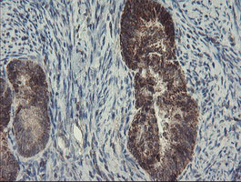 IHC of paraffin-embedded Adenocarcinoma of Human endometrium tissue using anti-SKIL mouse monoclonal antibody.
