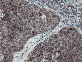 IHC of paraffin-embedded Carcinoma of Human pancreas tissue using anti-SKIL mouse monoclonal antibody.