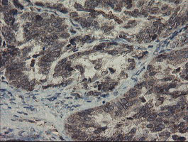 IHC of paraffin-embedded Adenocarcinoma of Human ovary tissue using anti-SKIL mouse monoclonal antibody.