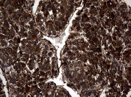 IHC of paraffin-embedded Carcinoma of Human liver tissue using anti-SKIL mouse monoclonal antibody.