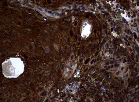 IHC of paraffin-embedded Carcinoma of Human lung tissue using anti-SKIL mouse monoclonal antibody.