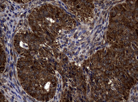 IHC of paraffin-embedded Adenocarcinoma of Human ovary tissue using anti-SKIL mouse monoclonal antibody.