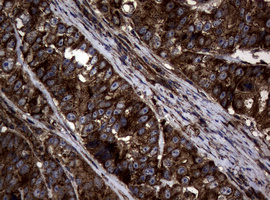 IHC of paraffin-embedded Adenocarcinoma of Human colon tissue using anti-SKIL mouse monoclonal antibody.