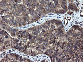 IHC of paraffin-embedded Adenocarcinoma of Human ovary tissue using anti-SKIL mouse monoclonal antibody.