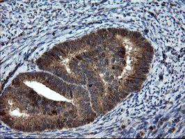 IHC of paraffin-embedded Adenocarcinoma of Human endometrium tissue using anti-SKIL mouse monoclonal antibody.