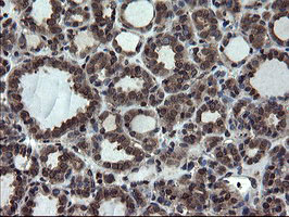 IHC of paraffin-embedded Carcinoma of Human thyroid tissue using anti-SKIL mouse monoclonal antibody.