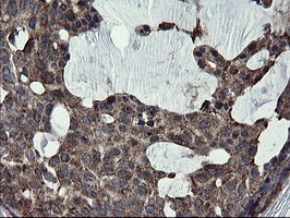 IHC of paraffin-embedded Adenocarcinoma of Human breast tissue using anti-SKIL mouse monoclonal antibody.