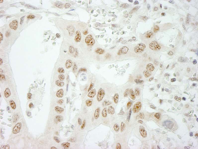 Detection of Human SKIV2L2 by Immunohistochemistry. Sample: FFPE section of human lung adenocarcinoma. Antibody: Affinity purified rabbit anti-SKIV2L2 used at a dilution of 1:250. Epitope Retrieval Buffer-High pH (IHC-101J) was substituted for Epitope Retrieval Buffer-Reduced pH.
