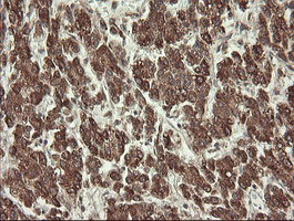 IHC of paraffin-embedded Carcinoma of Human liver tissue using anti-PROSC mouse monoclonal antibody.