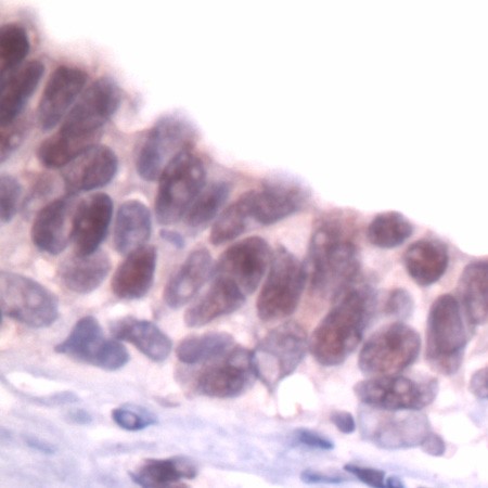 Human breast carcinoma stained with Anti-Skp1 p19
