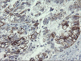 IHC of paraffin-embedded Adenocarcinoma of Human ovary tissue using anti-SLA2 mouse monoclonal antibody.